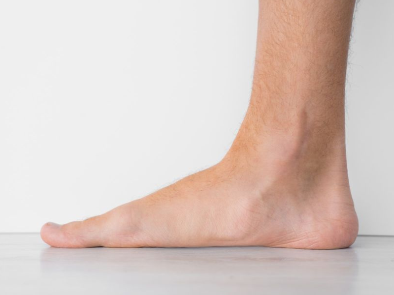 Artículo sobre Tratamiento Integral del Pie Plano ofrecido por Dr. Francisco Castillo Vazquez